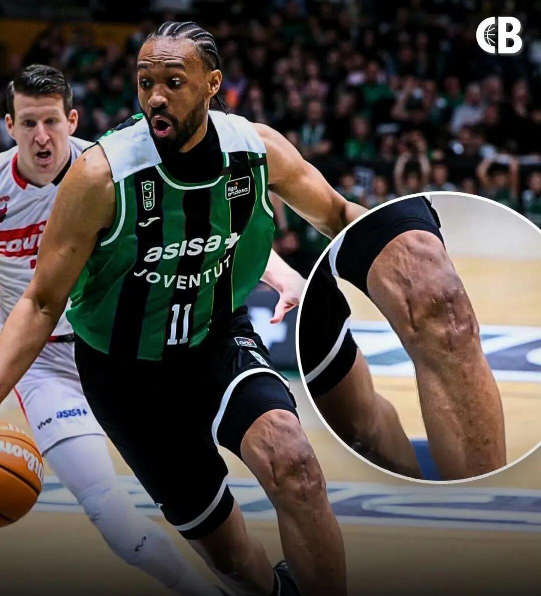 8868体育官网-好可怕的膝盖！两次ACL撕裂，他还在打球！！！